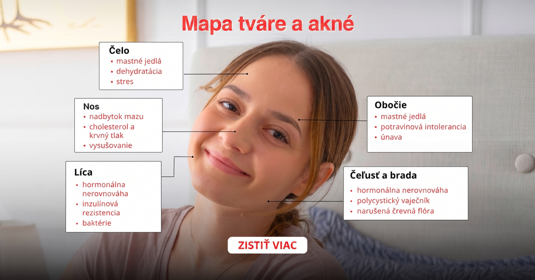 Mapa tváre pri akné podľa zón