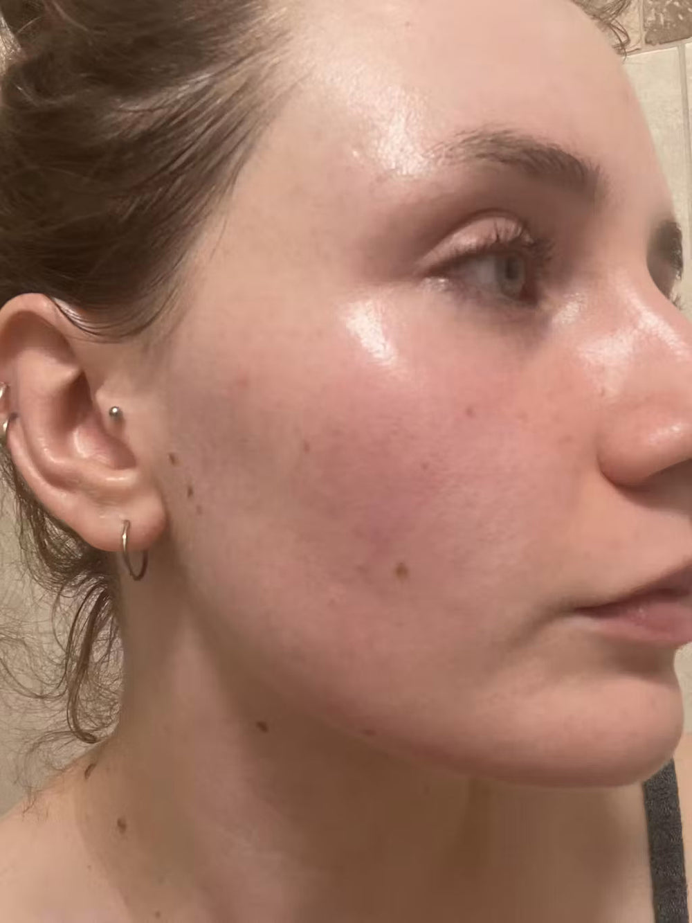 acne SK keep
