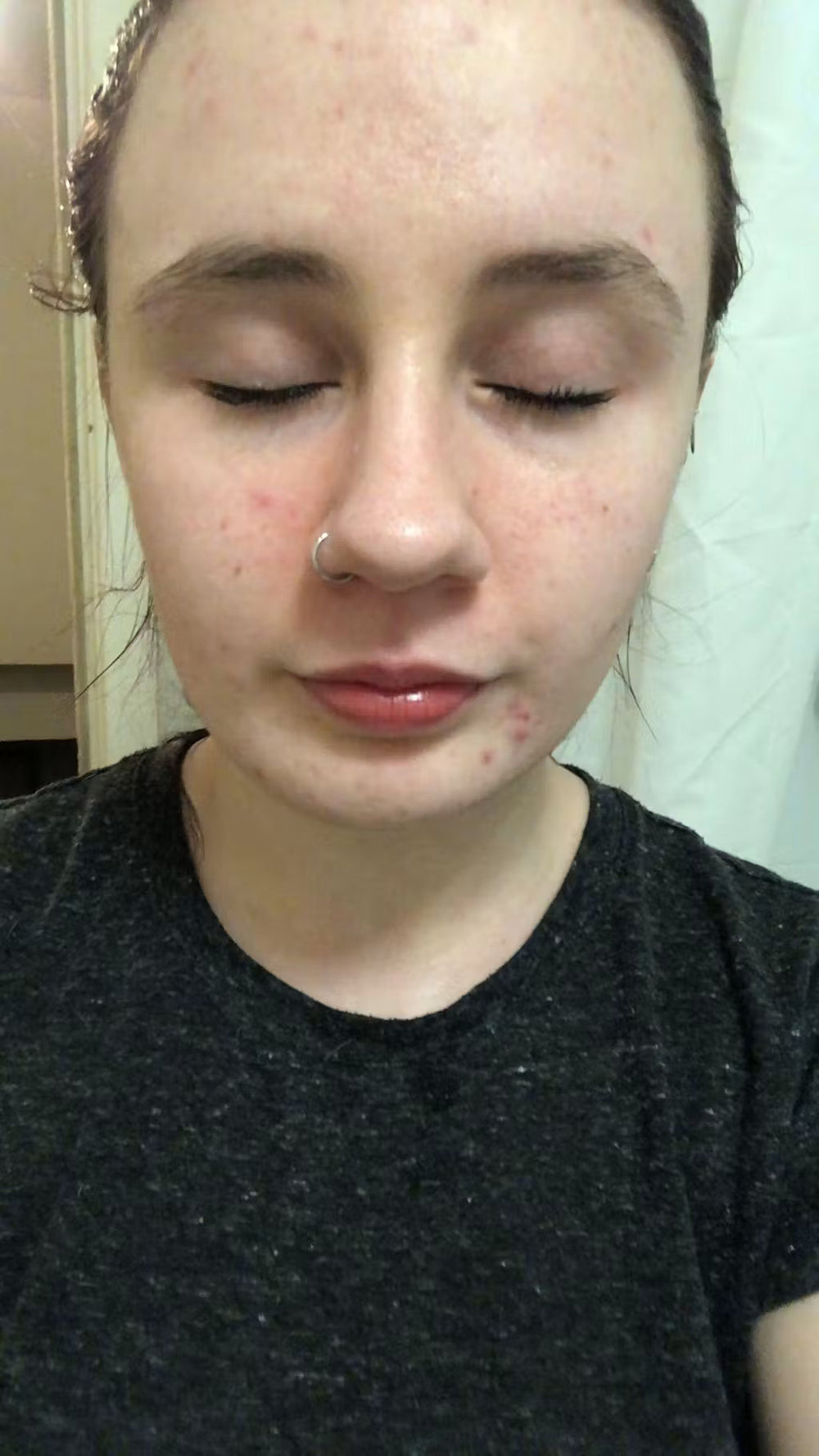acne SK keep