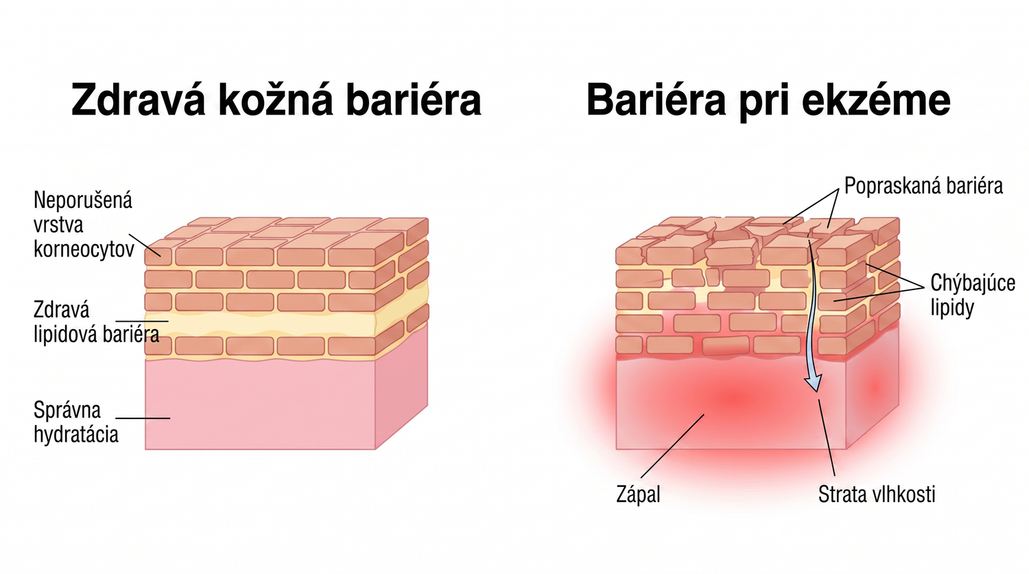 eczema_SK_skin_barrier_v2.png