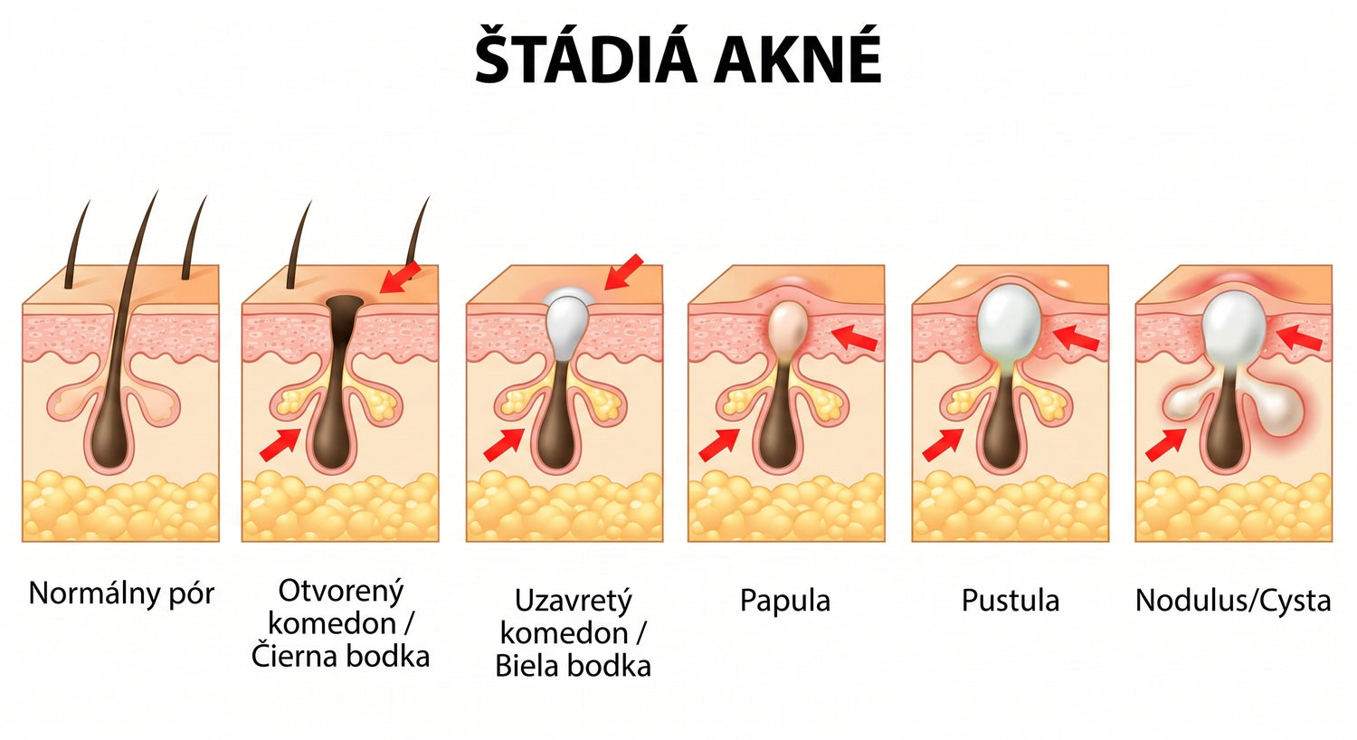 acne SK translated