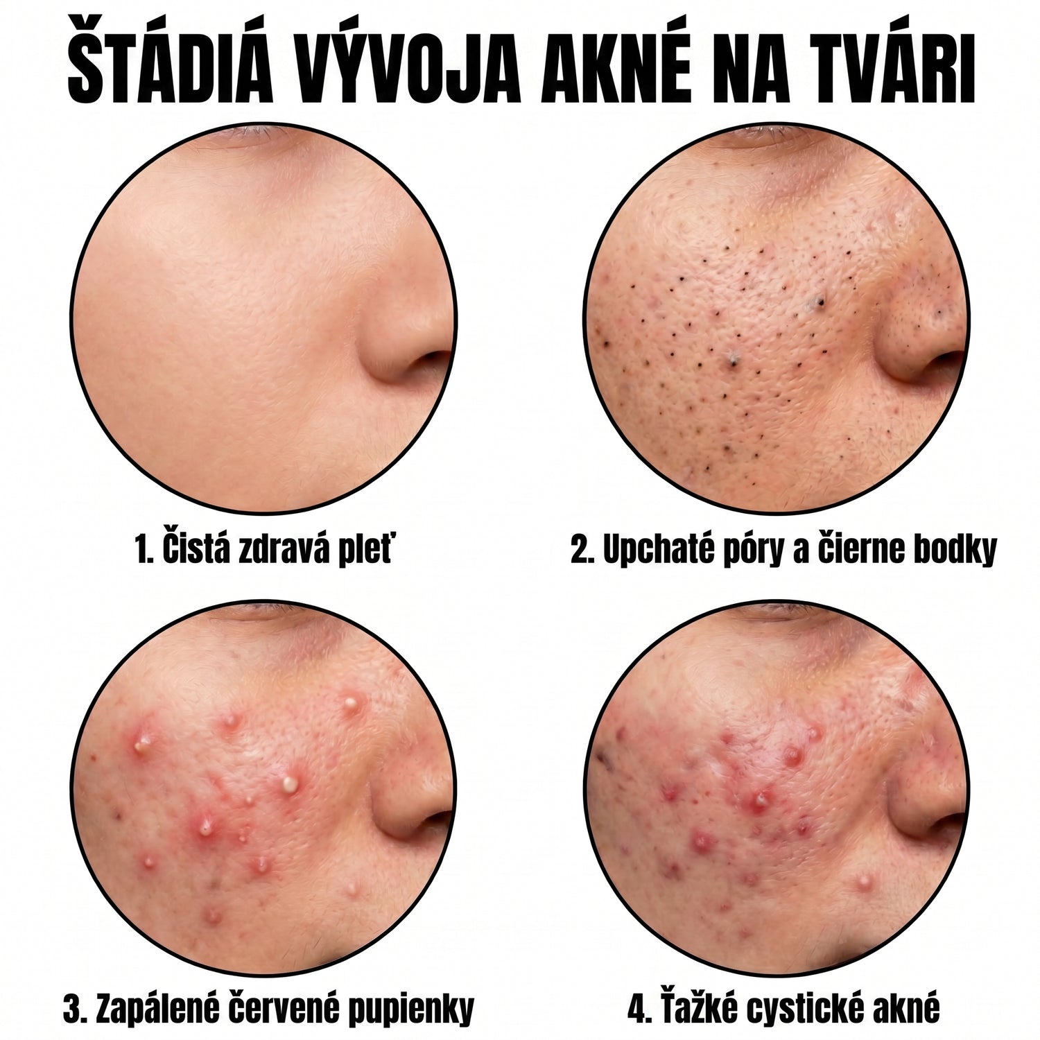 acne SK translated